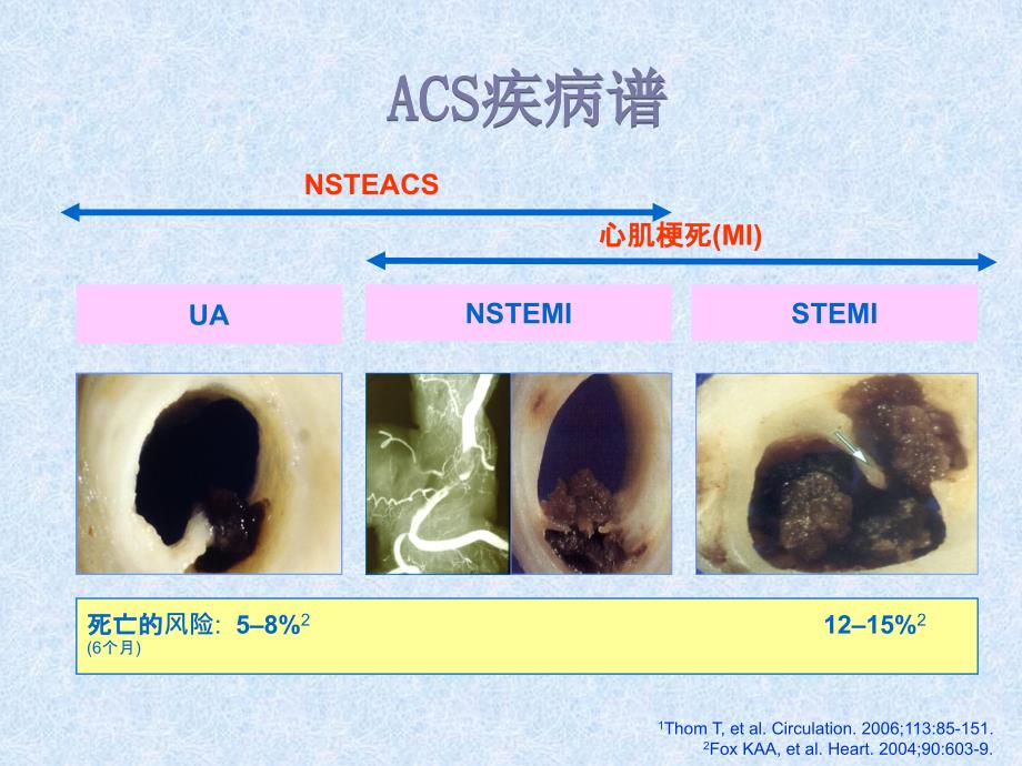 NSTEACS的诊断和治疗——齐国先_第4页