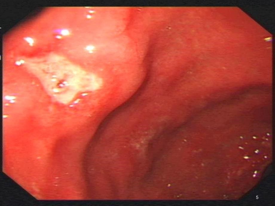 上消化道出血的完整版课堂PPT_第5页