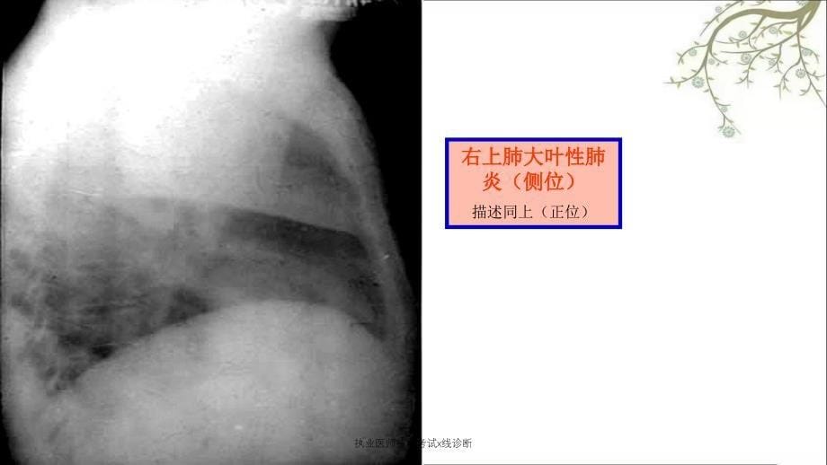 执业医师技能考试x线诊断_第5页