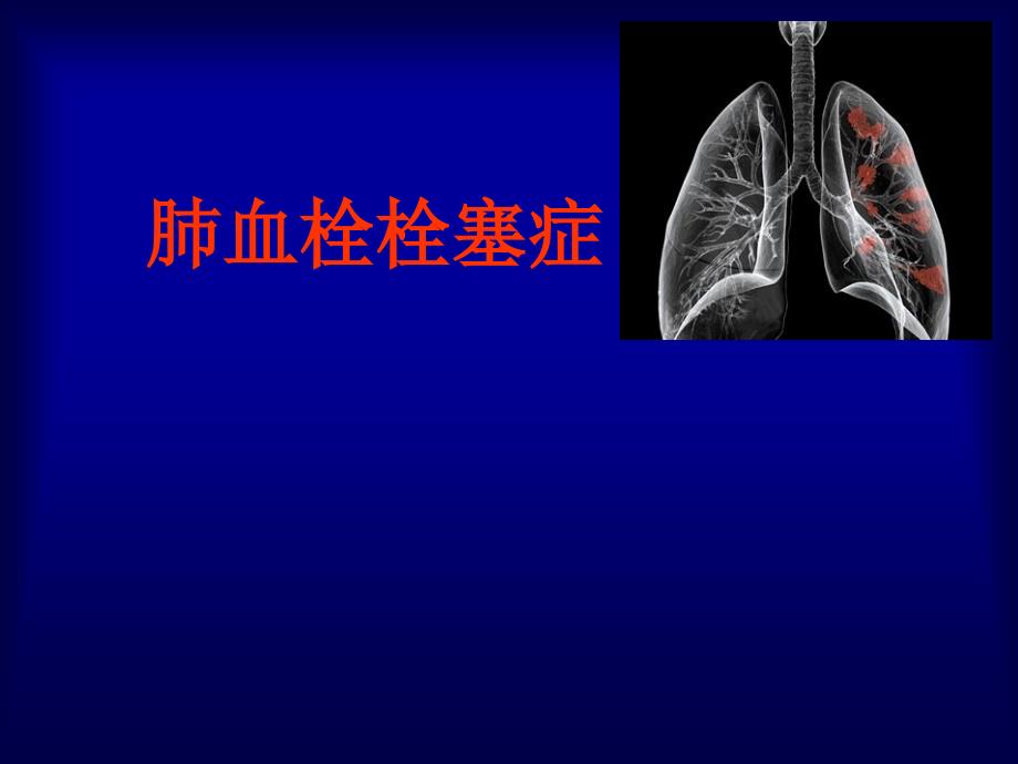 内科学教学课件：肺血栓栓塞症_第1页