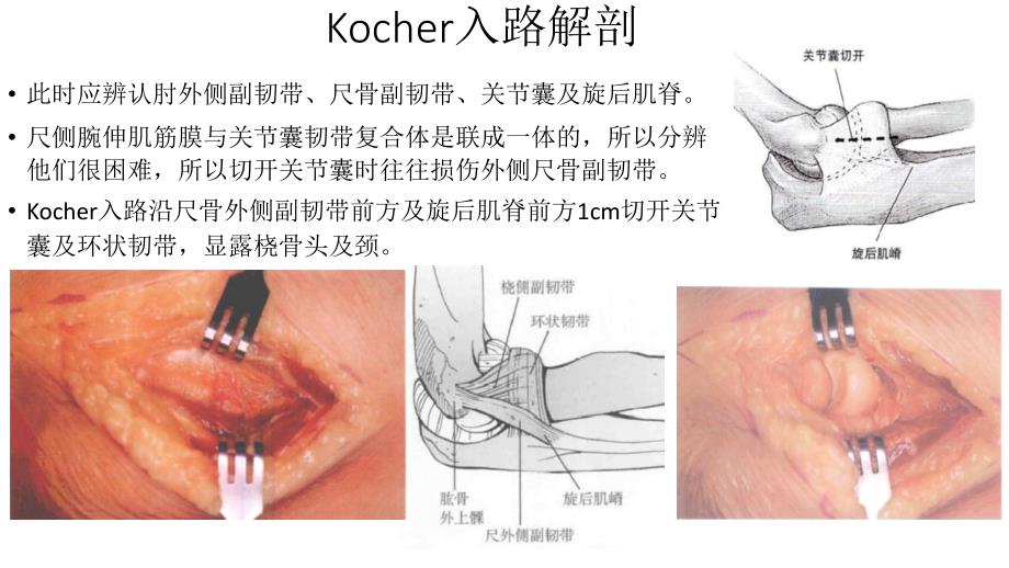 肘关节外侧入路解剖_第3页