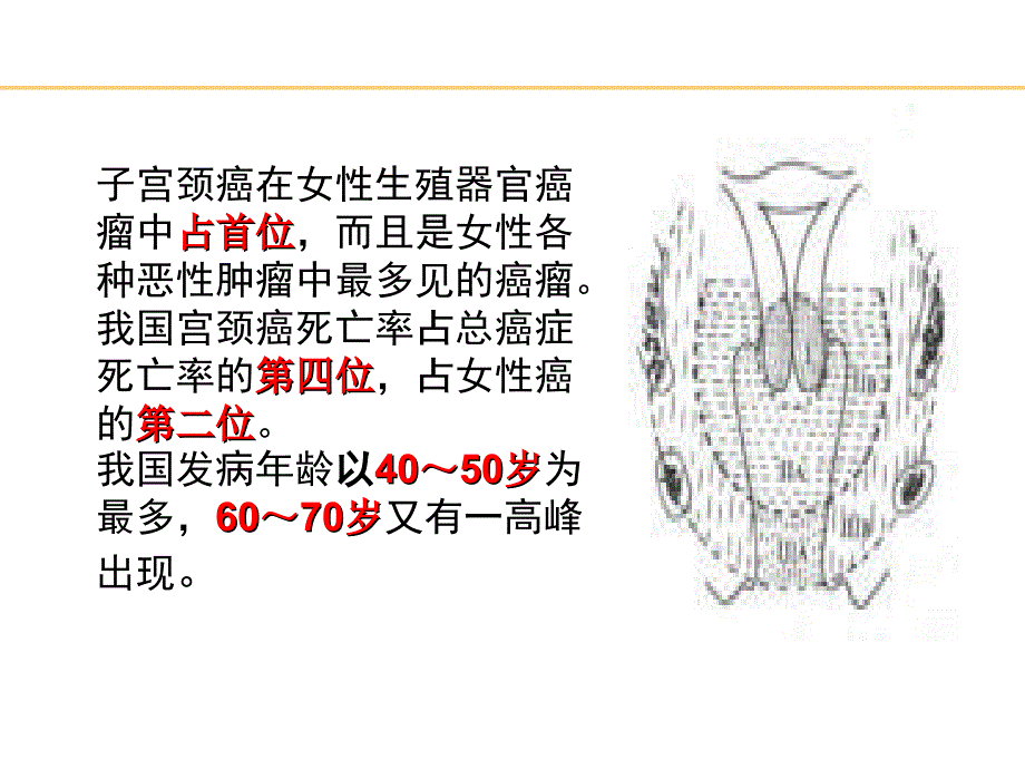 子宫颈癌PPT课件_第4页