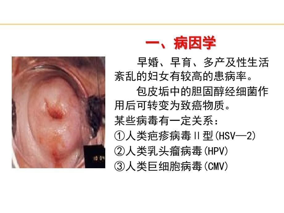 子宫颈癌PPT课件_第5页