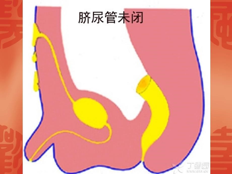 脐尿管病变的CT表现_第5页