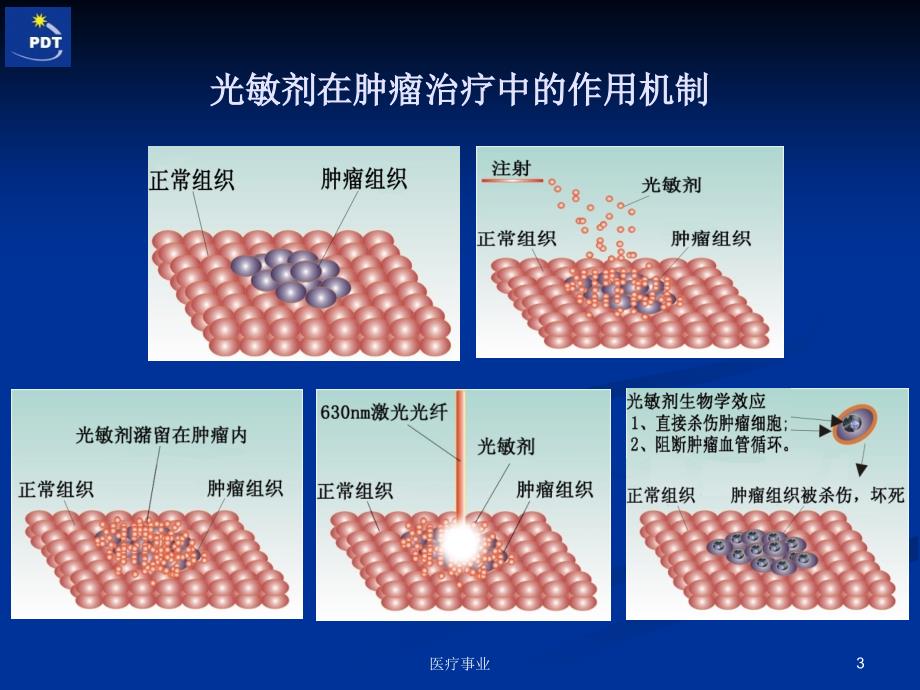 肿瘤光动力治疗项目治疗方案护理方案术前准备术后观察医术材料_第3页