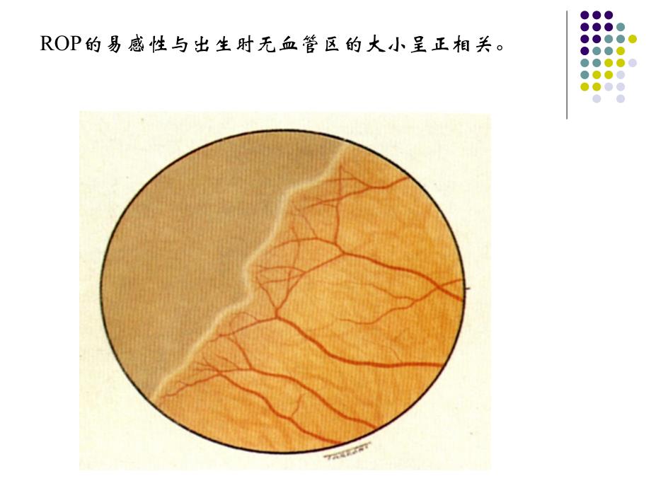 早产儿视网膜病_第3页