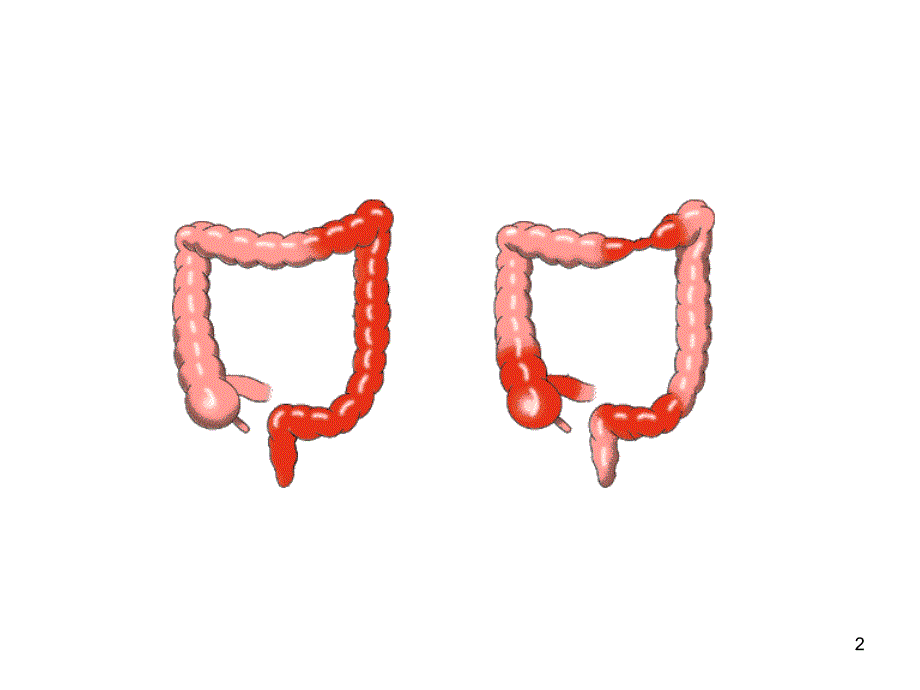 溃疡性结肠炎图片PPT演示课件_第2页