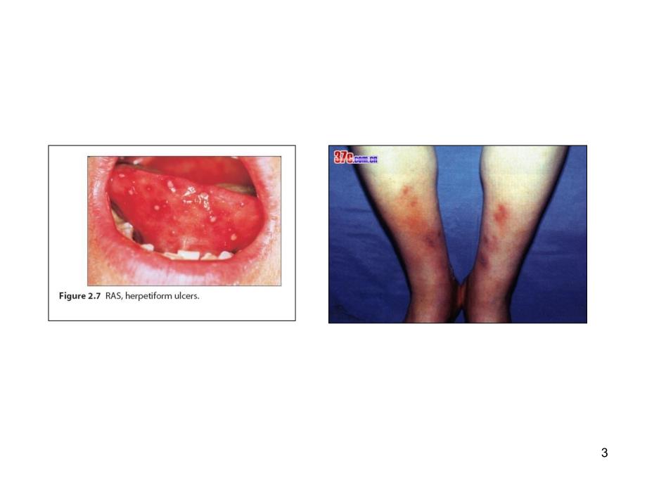 溃疡性结肠炎图片PPT演示课件_第3页