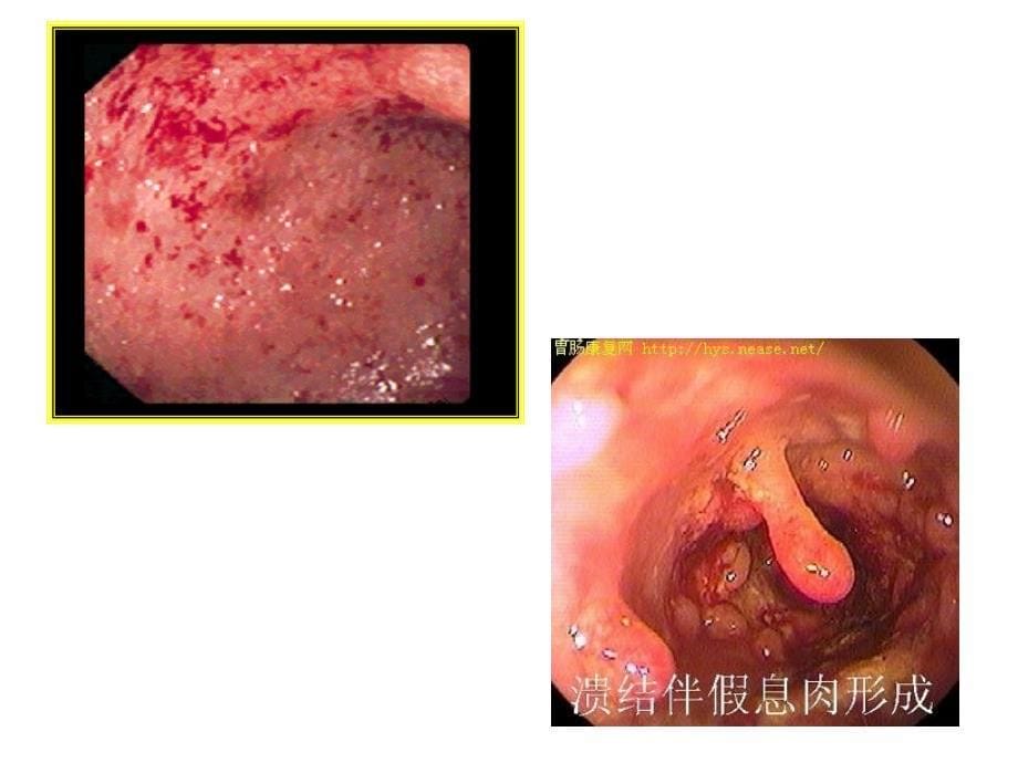 溃疡性结肠炎图片PPT演示课件_第5页
