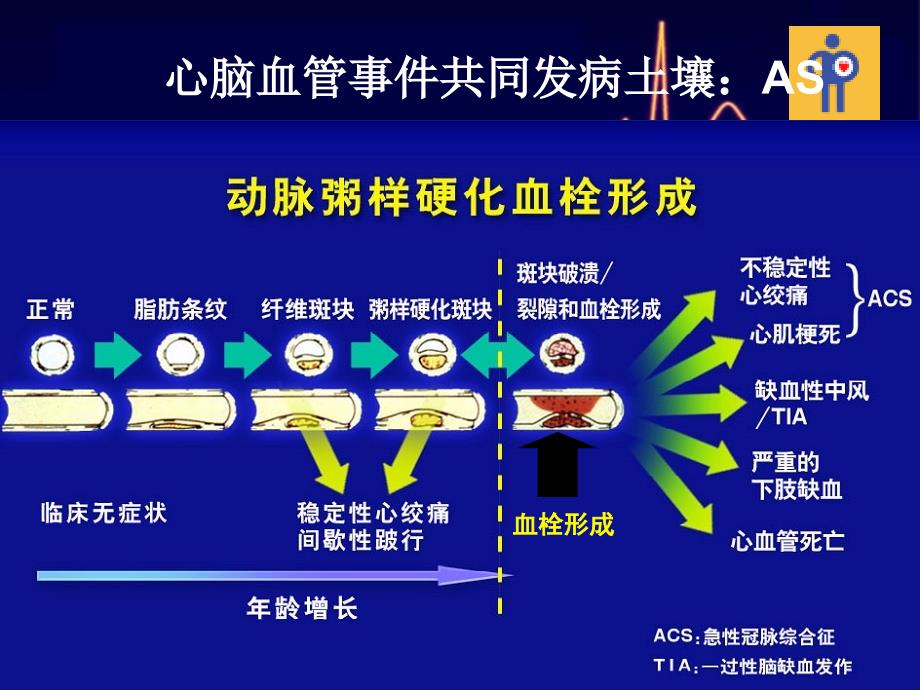 合并脑卒中的急性冠脉综合征患者抗栓治疗_第3页