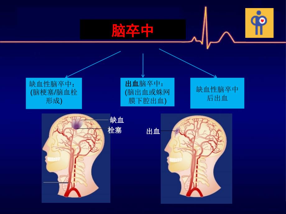 合并脑卒中的急性冠脉综合征患者抗栓治疗_第4页