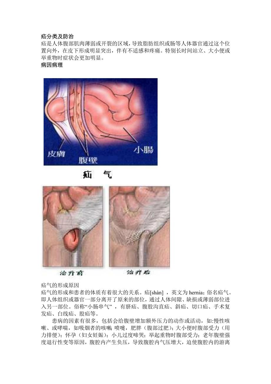 疝分类及防治.doc_第1页