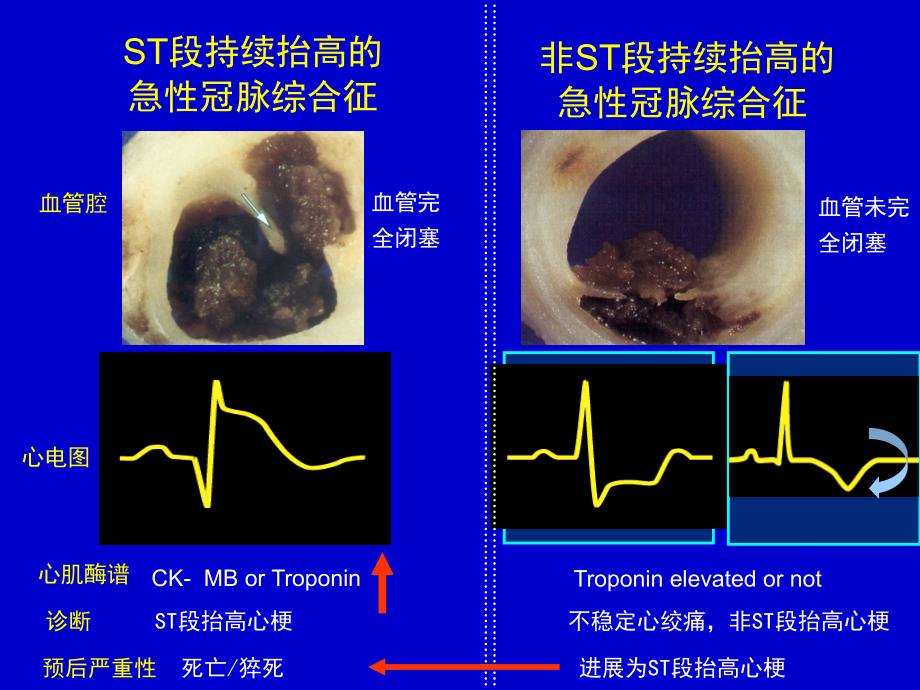 急性心肌梗死PPT课件_第3页