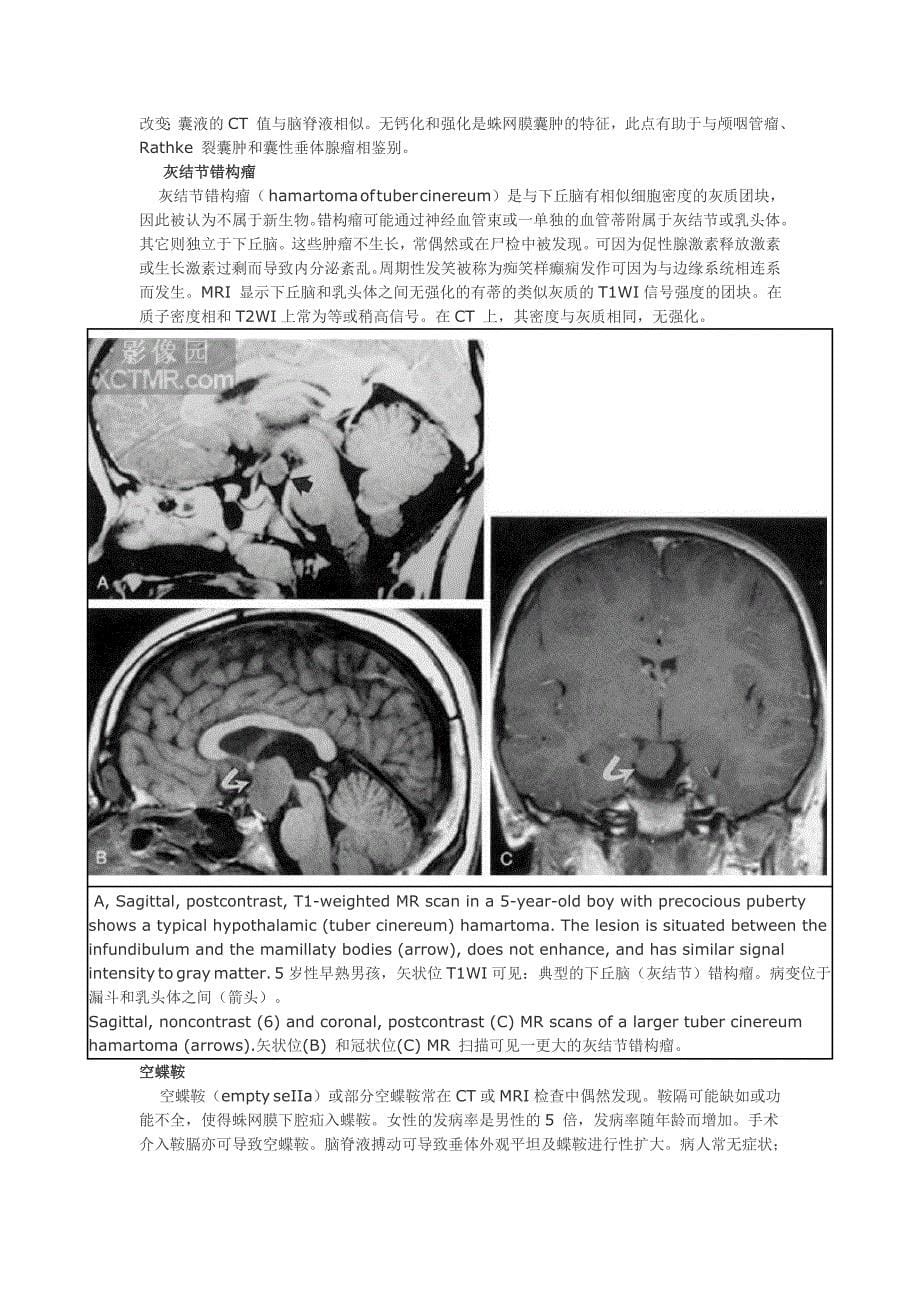 蝶鞍及鞍旁病变的诊断及鉴别诊断_第5页