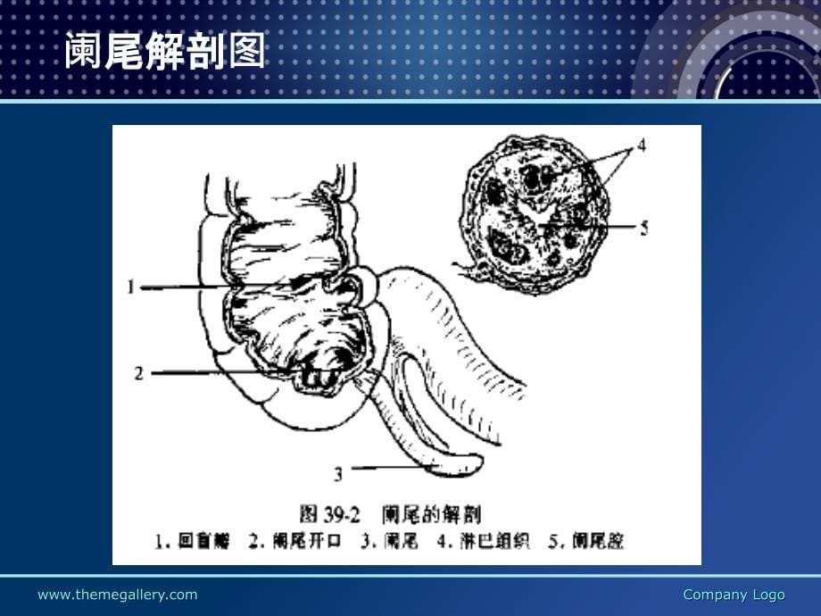 阑尾炎诊断治疗手术课件_第5页