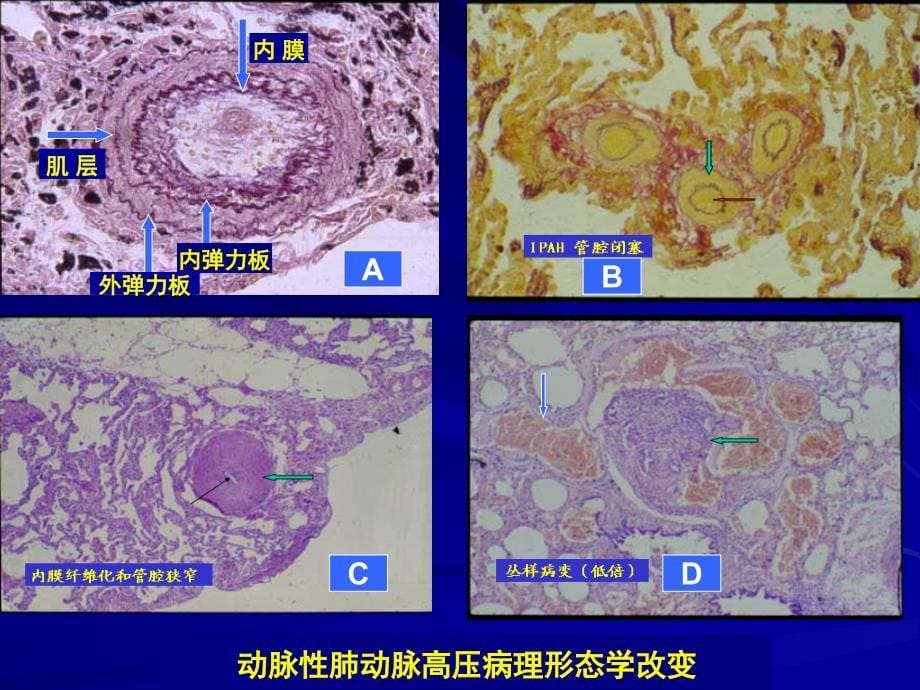 特发性肺动脉高压的诊断_第5页