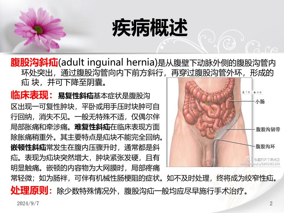 腹股沟斜疝护理查房课件_第2页