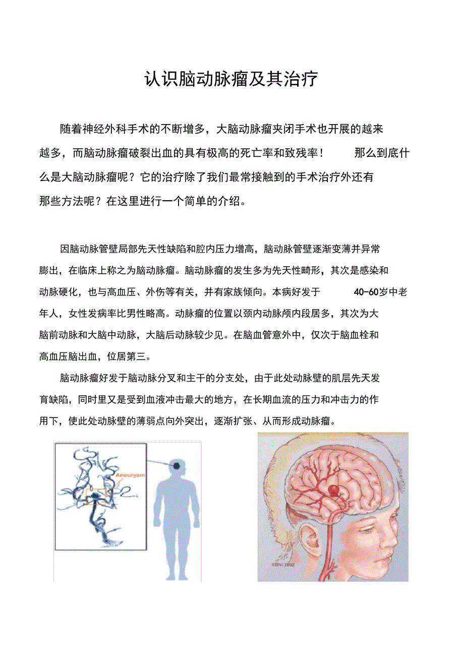 脑动脉瘤的概述与治疗_第1页