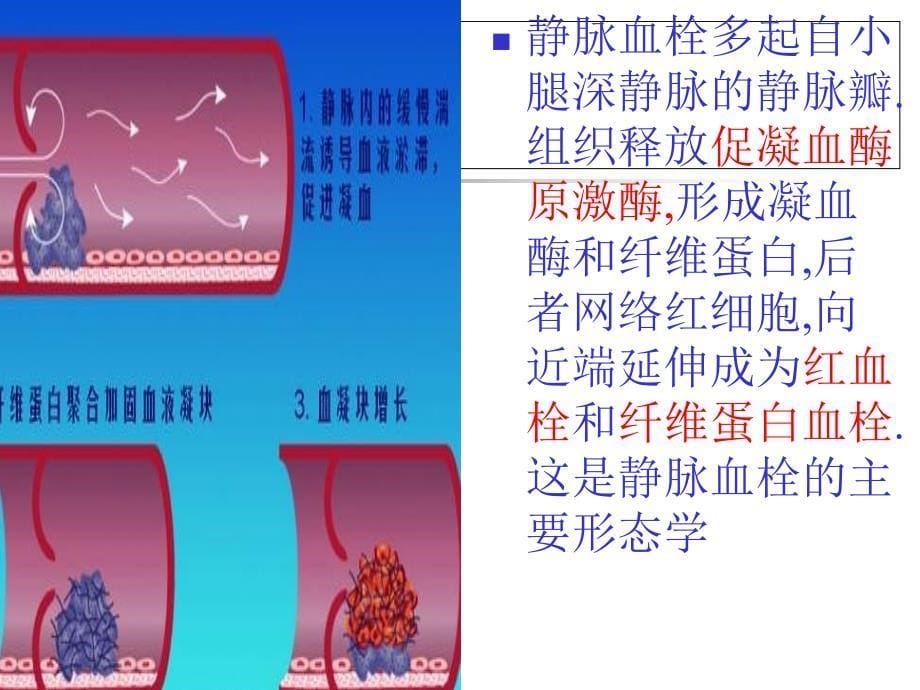 下肢深静脉血栓的诊断与治疗进展_第5页