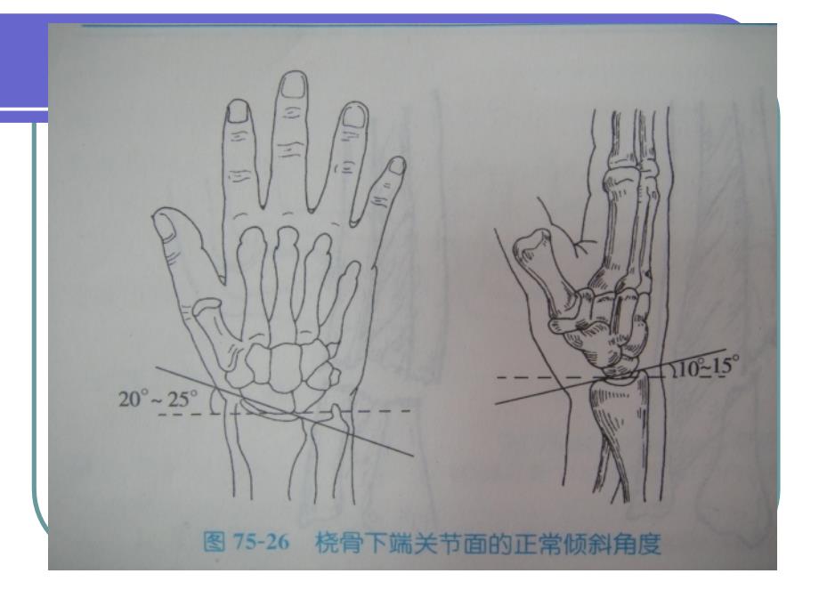 医学专题：桡骨远端骨折(ppt)_第4页