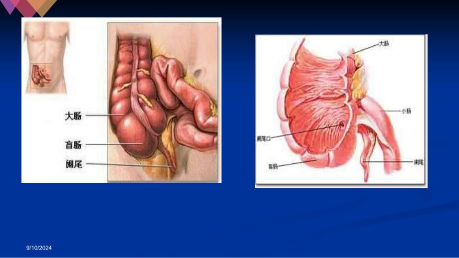 开腹阑尾的护理查房课件_第3页