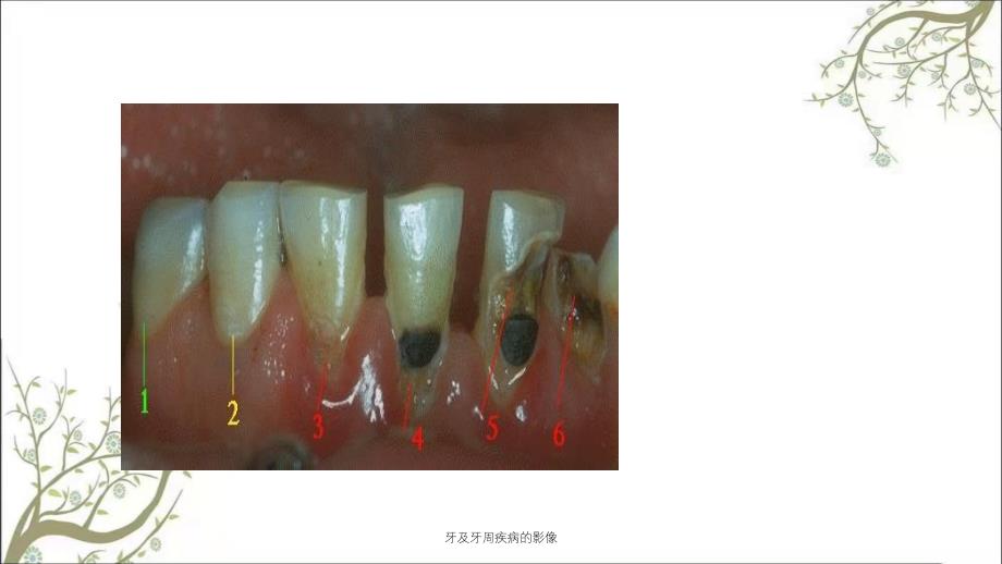 牙及牙周疾病的影像_第3页