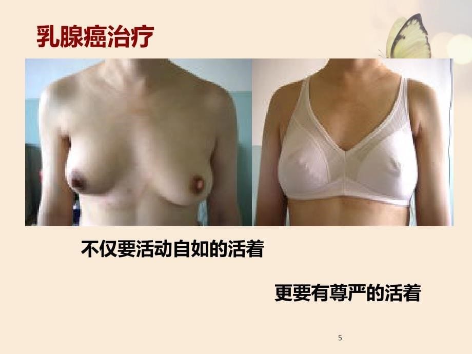 乳腺癌的个体化治疗及全程管理ppt课件_第5页