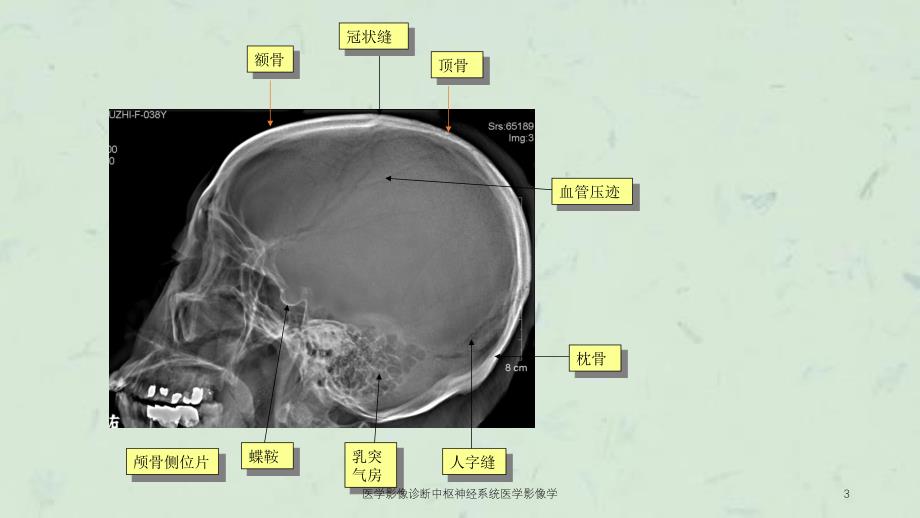 医学影像诊断中枢神经系统医学影像学课件_第3页