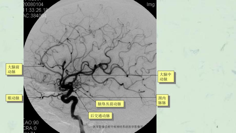 医学影像诊断中枢神经系统医学影像学课件_第4页