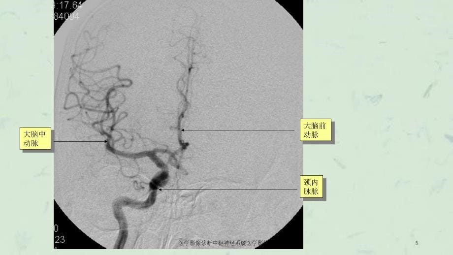 医学影像诊断中枢神经系统医学影像学课件_第5页