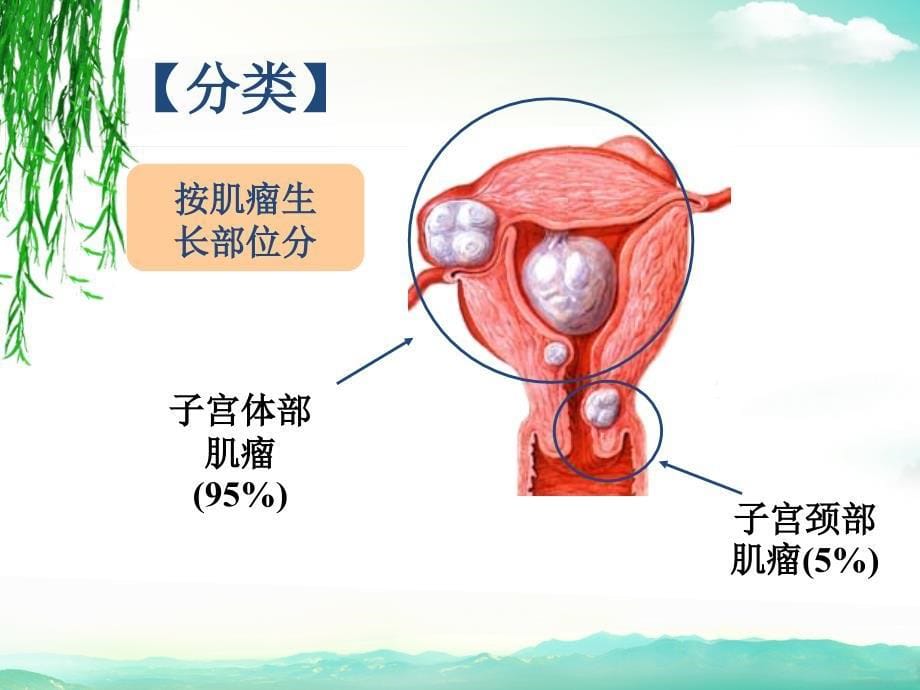 子宫肌瘤的教学查房_第5页