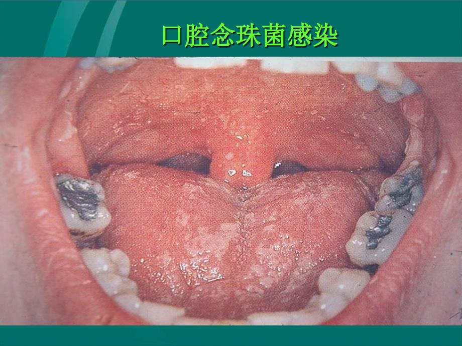 艾滋病团员知识宣传ppt课件_第2页