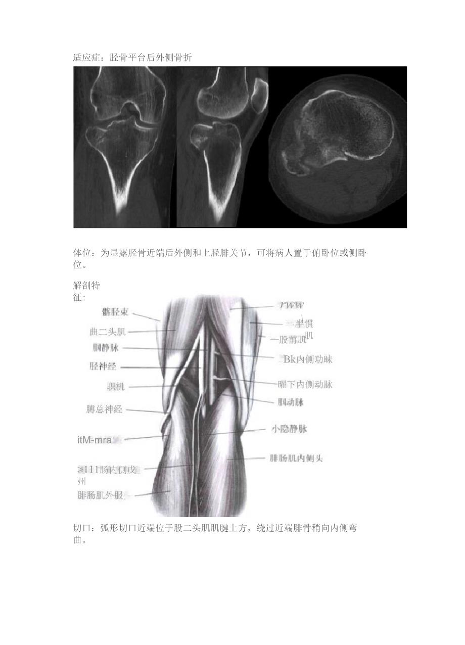 胫骨近端后外侧入路_第1页