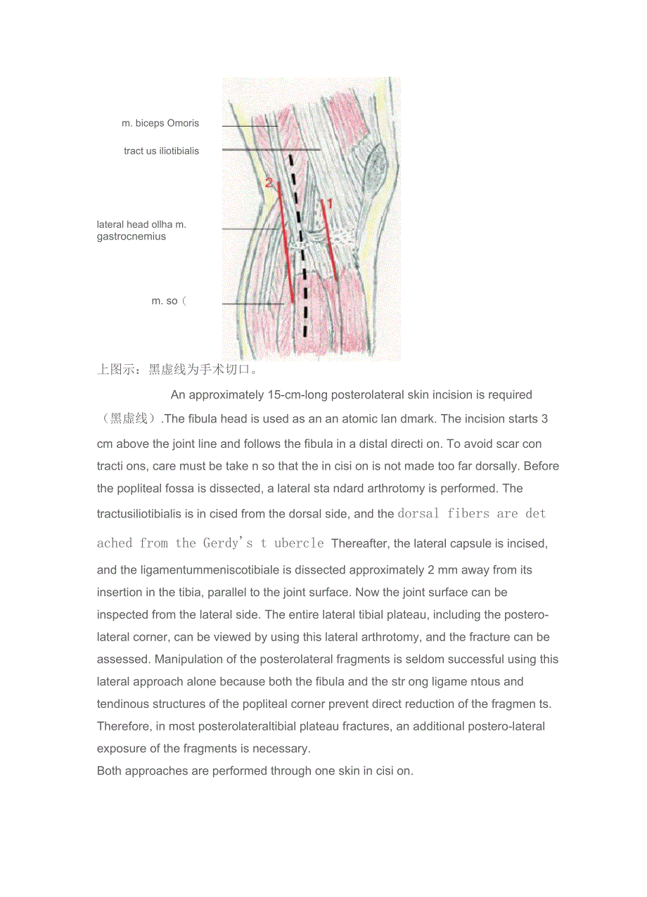 胫骨近端后外侧入路_第2页