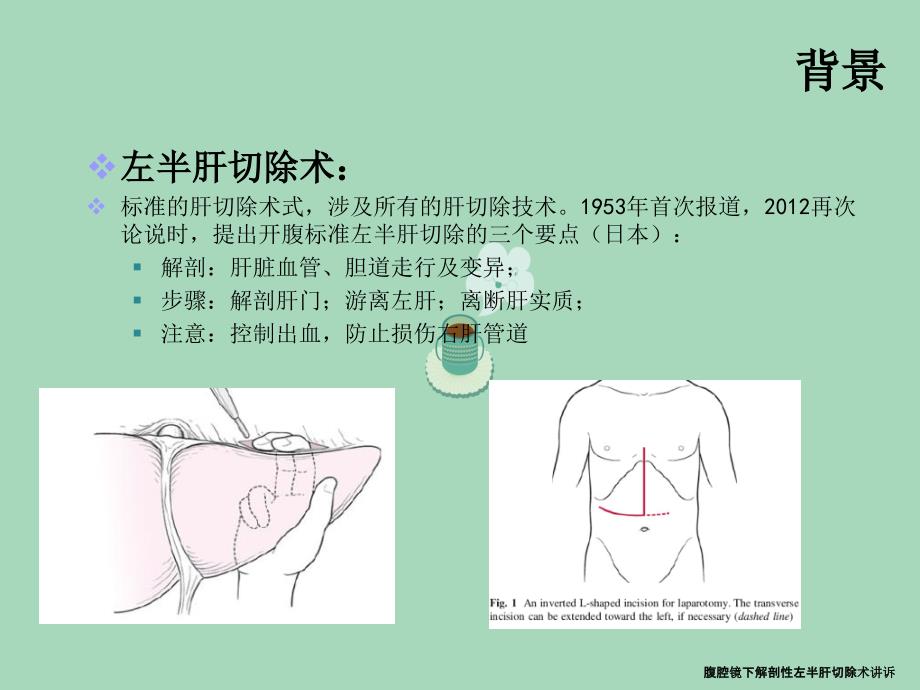 腹腔镜下解剖性左半肝切除术讲诉_第3页