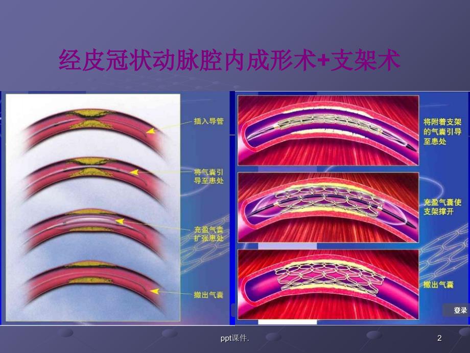 冠状动脉造影ppt课件_第2页