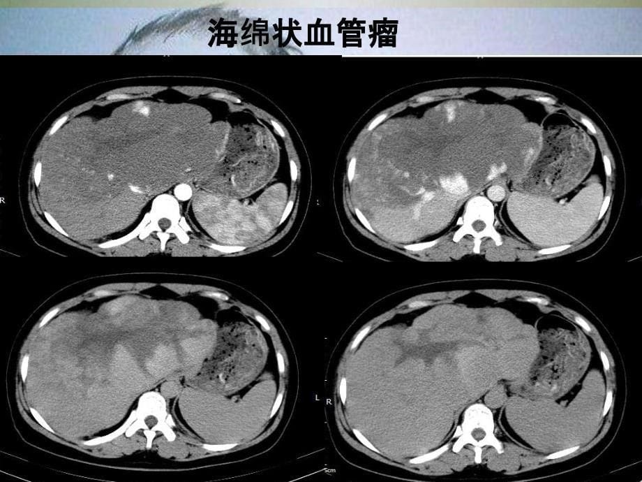 肝脏常见瘢痕性病变_第5页