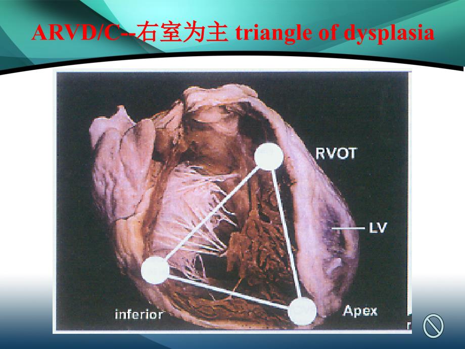 致心律失常性右室心肌病.ppt_第5页