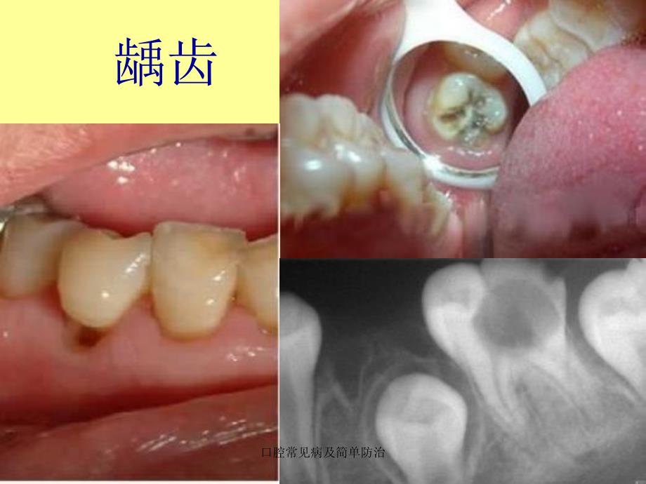 口腔常见病及简单防治_第4页