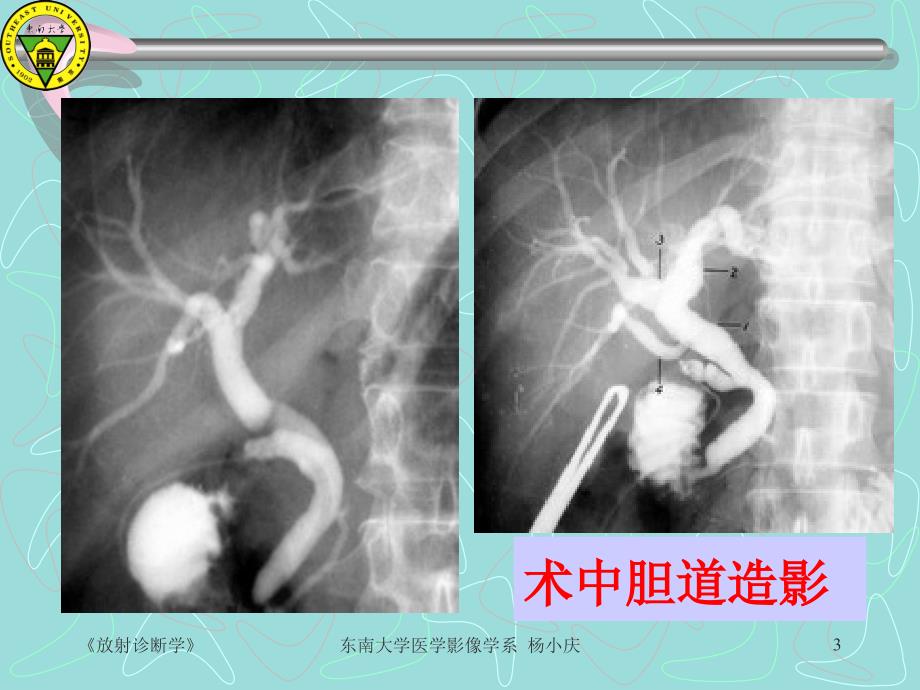 梗阻性黄疸的影像学诊断_第3页