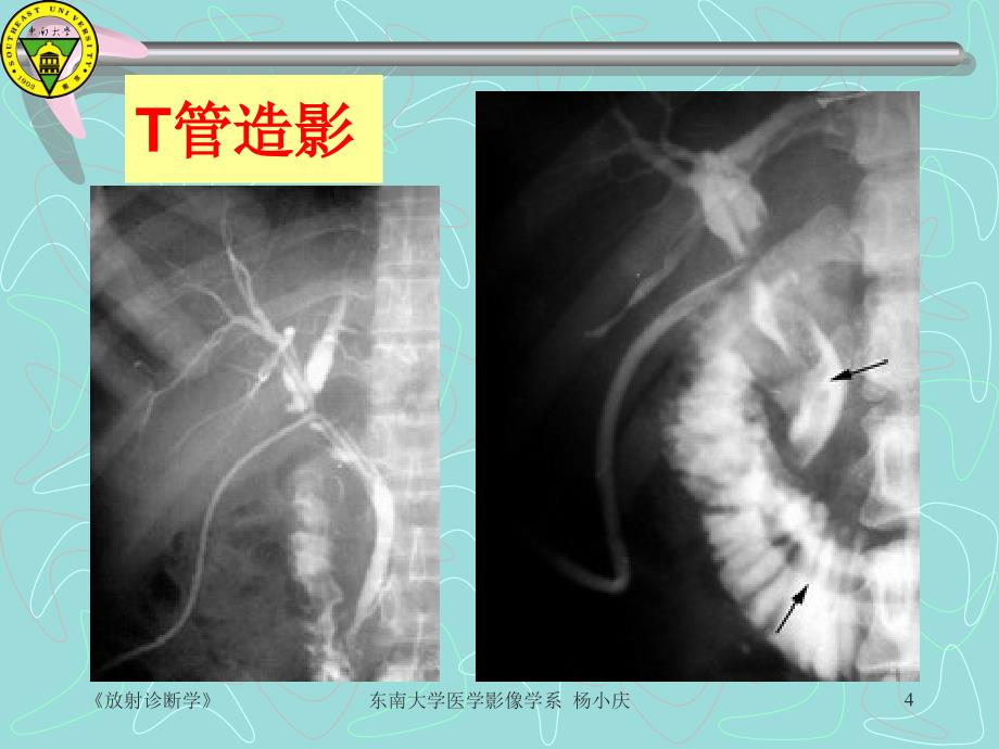 梗阻性黄疸的影像学诊断_第4页