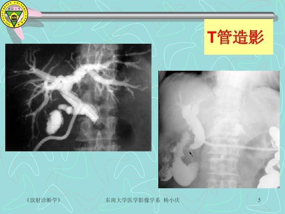 梗阻性黄疸的影像学诊断_第5页