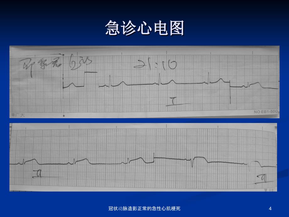 冠状动脉造影正常的急性心肌梗死课件_第4页