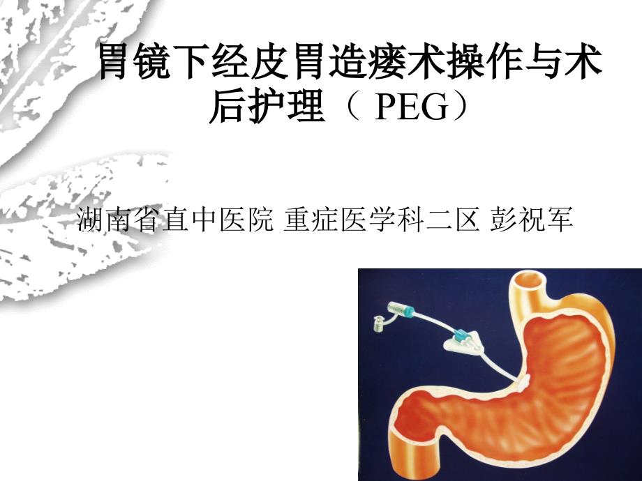 经皮胃镜下胃造瘘术操作与术后护理.ppt_第1页