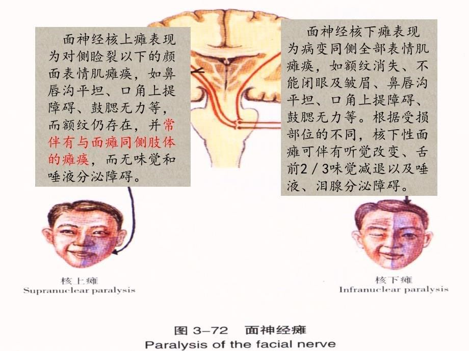 面神经炎、面瘫针灸康复治疗思路课件_第5页