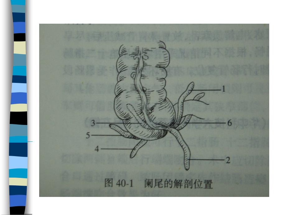 外科学教学课件：阑尾炎_第3页