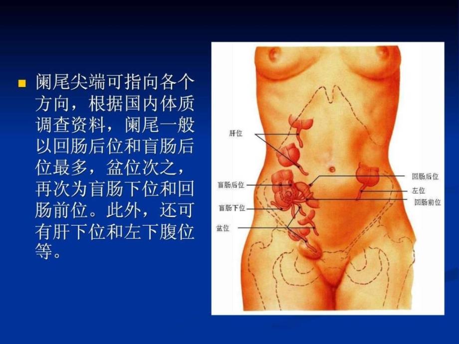 急性化脓性阑尾炎PPT课件_第3页