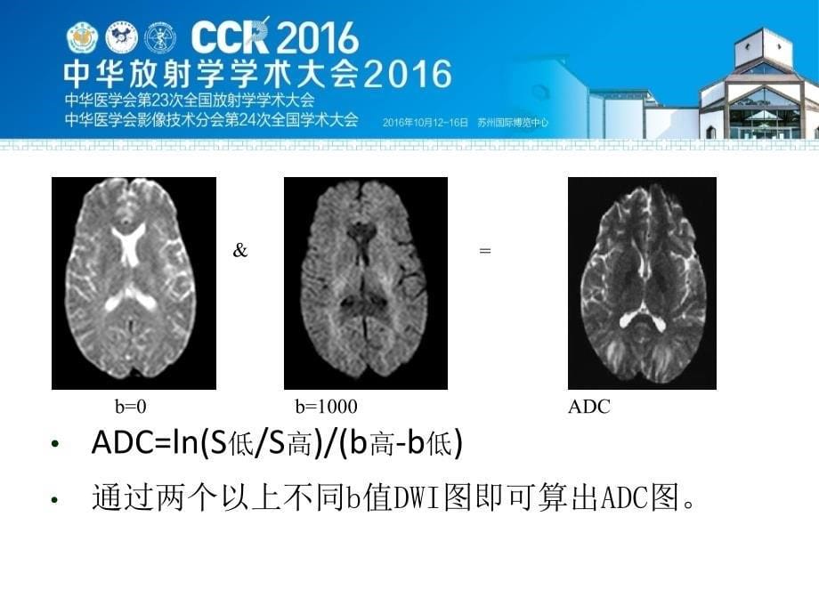 IVIM在评价肝癌TACE治疗反应的应用_第5页