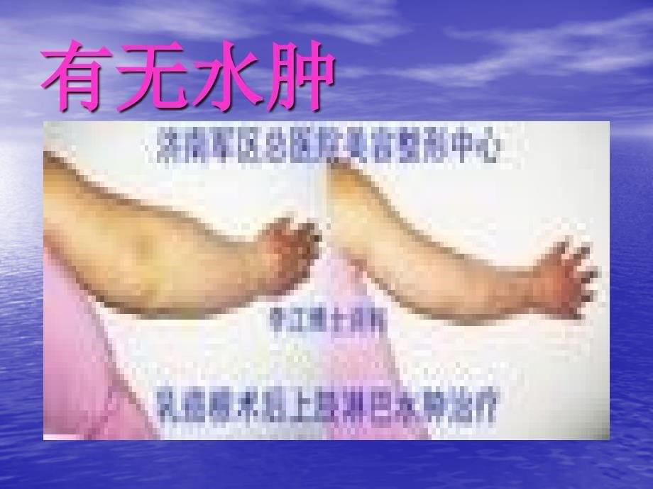 乳腺癌水肿的护理课件_第5页