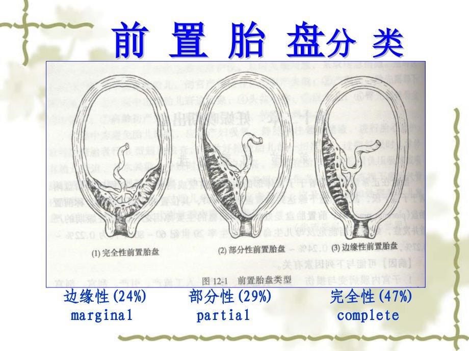 妇产科课件产前出血_第5页